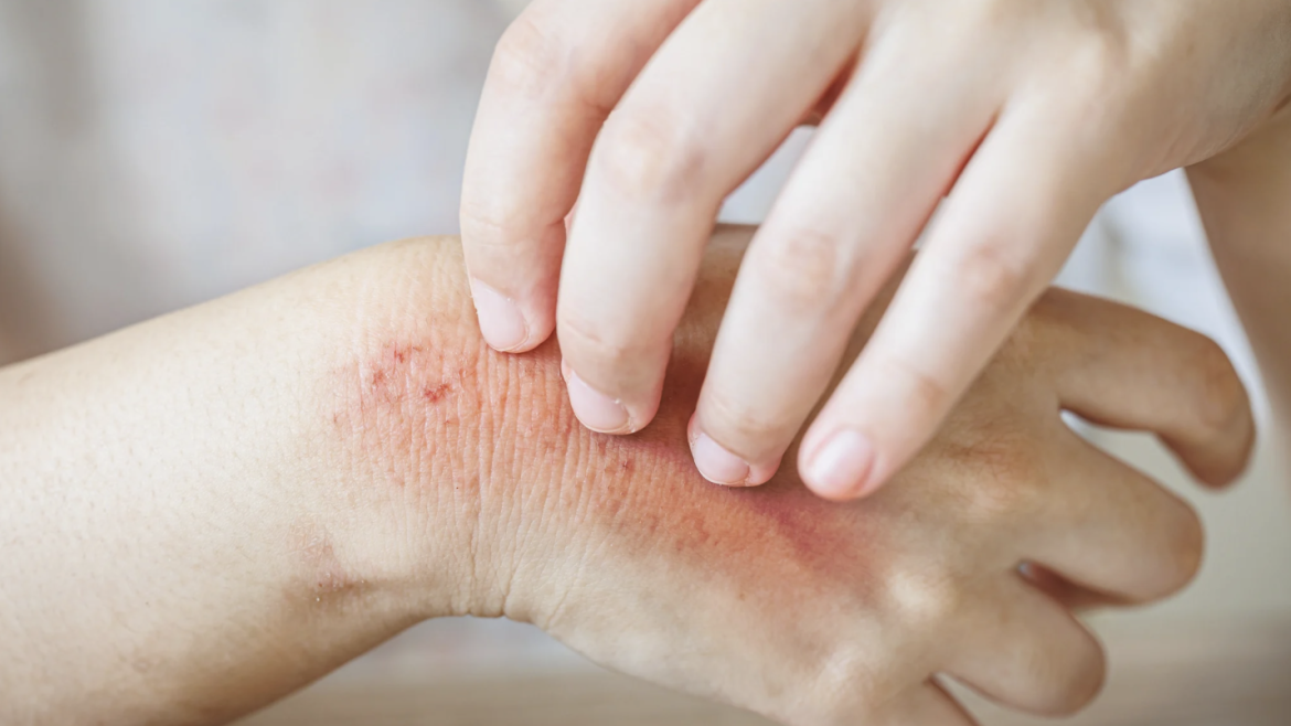 Same Day Dermatology Appointment for Rash Evaluation Near Fairfax, Virginia